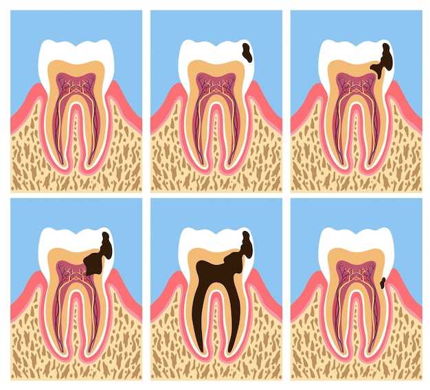 Losartan and Gum Disease: A Comprehensive Guide