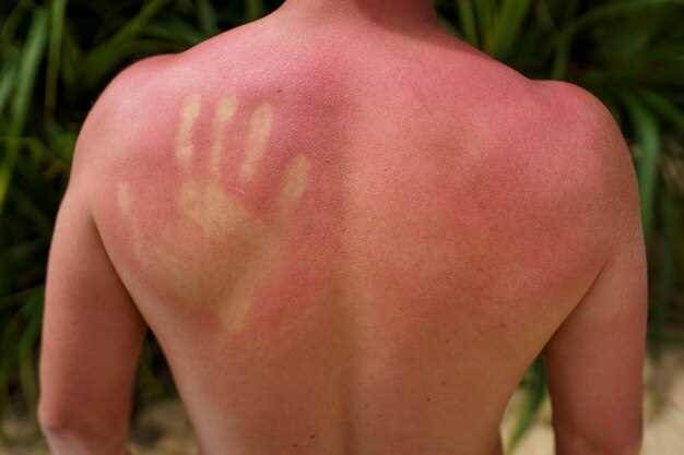 Losartan sun rash