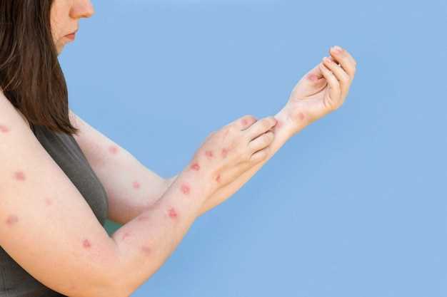 Rash from losartan